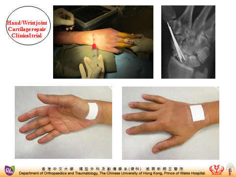 hand OA clincial trial